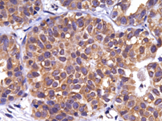G1P3 Overexpression in Early Stage Breast Cancer